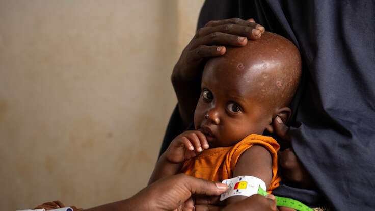  Two-year-old Mowlid eats a high protein peanut paste, also known as ready-to-use therapeutic food (RUTF), as treatment for his severe acute malnutrition. As part of our simplified approach, the IRC recommends providing RUTF as the primary treatment product for all children diagnosed with acute malnutrition. 